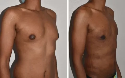 Gynecomastia before and after photos showcasing tummy tuck results.