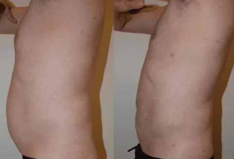 Gynecomastia before and after photos, showcasing the transformative results of a tummy tuck procedure.