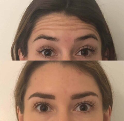 Before and after photos showcasing a woman's eyebrow transformation with Injectables.