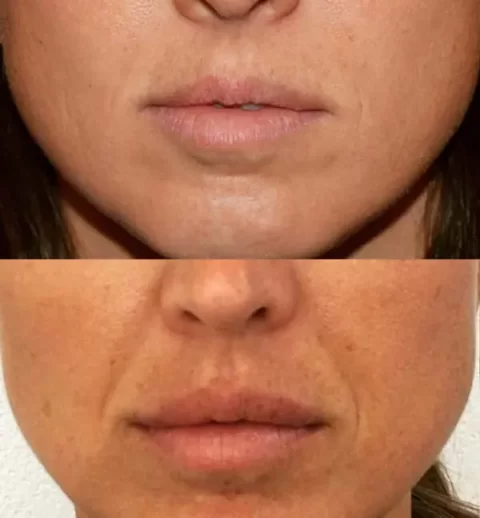 A woman's lips showcasing the remarkable transformation achieved through lip injections.