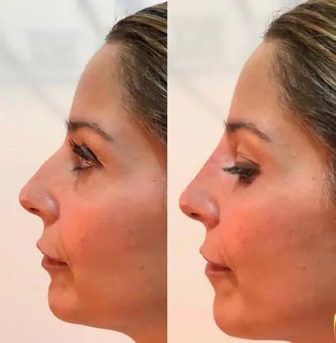 Before and after photos of a woman's rhinoplasty showcasing dramatic transformations.