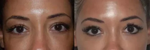 Injectables before and after photos showcasing a woman's rejuvenated eyelids.
