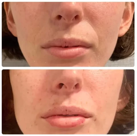 Injectables before and after photos showcasing a woman's transformed lips.