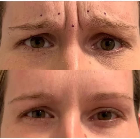 Injectables Before and After Photos showcasing a woman's eyebrows transformation.