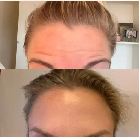 Injectables Before and After Photos of a woman's eyebrows.