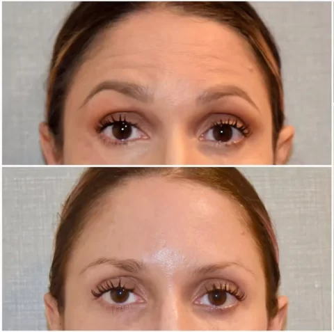 Injectables before and after photos of a woman's eyebrows.