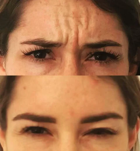 Injectables before and after photos of a woman's eyebrows.