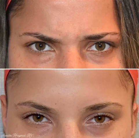 Injectables before and after photos showcasing a woman's eyebrows transformation.