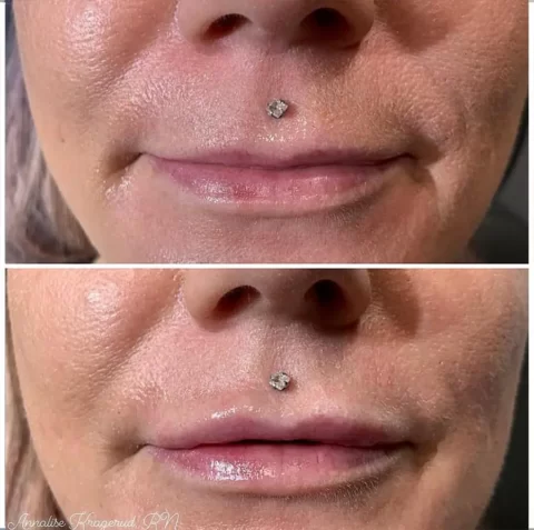 Before and after pictures of a woman with a nose piercing showcasing the transformation achieved through injectables.