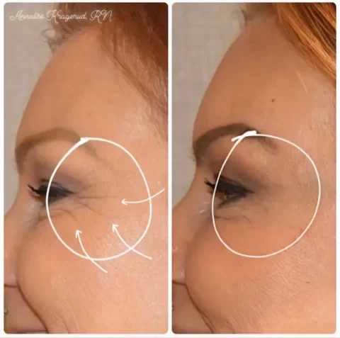 Injectables Before and After Photos of a woman's eyebrows.