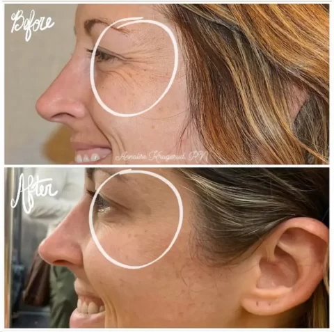 Injectables Before and After Photos of a woman's face.