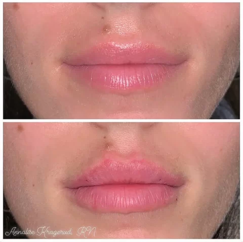 A woman's lips showcased in injectables before and after photos, highlighting the visible transformation achieved through lip filler.