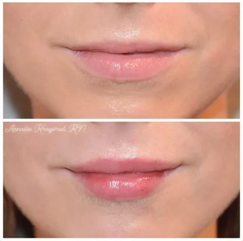 Injectables Before and After Photos of a woman's lips.