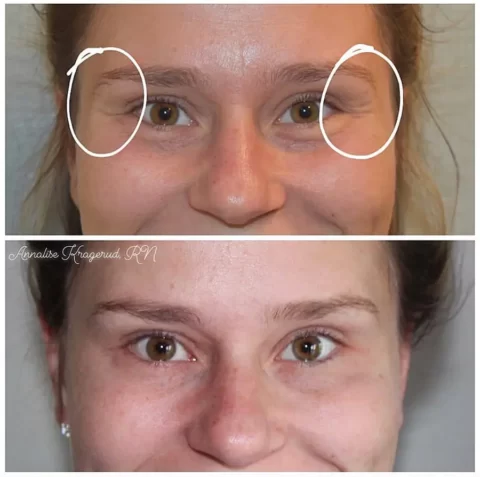 Injectables before and after photos showcasing a woman's eyebrows transformation.