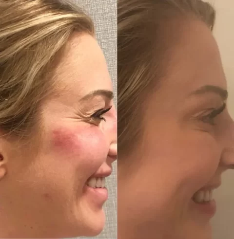 Injectables before and after photos showcasing a woman's face transformation.