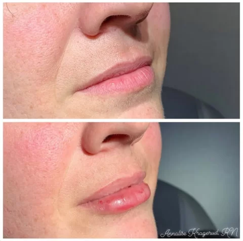 View stunning before and after photos of a woman's lips enhanced with injectables.