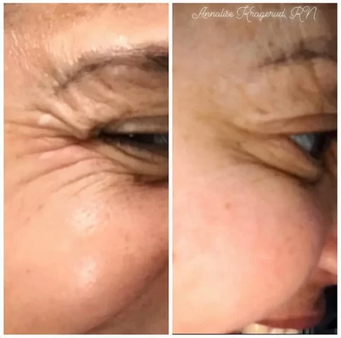 Injectables before and after photos showcasing a woman's wrinkles.
