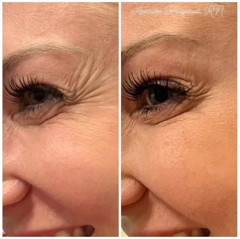 Injectables before and after photos showcasing a woman's transformed eyebrows.
