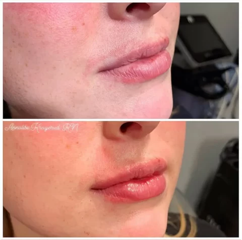 A woman's lips showcasing the transformation after undergoing lip injections.