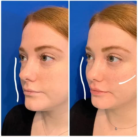 Before and after photos of a woman's rhinoplasty showcasing the transformative results of the procedure.