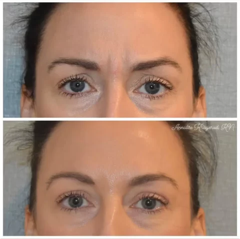 A woman's eyebrows before and after injectables treatment.
