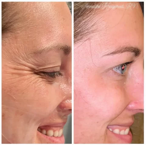 Injectables before and after photos showcasing the transformation of a woman's face with wrinkles.