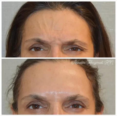 Injectables before and after photos showcasing a woman's eyebrow transformation.