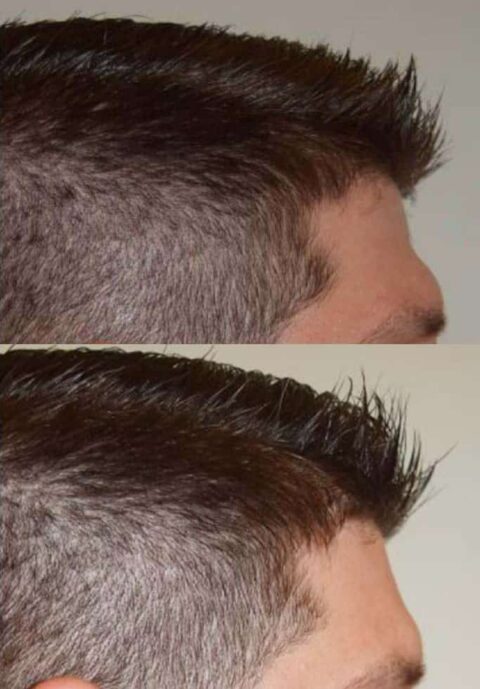 A man's hair transformation before and after a hair transplant, documented through captivating photos.