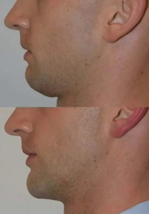 Before and after photos of a man's chin featuring the transformative effects of injectables.
