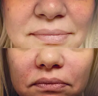 Injectables before and after photos showcasing a woman's face transformation.
