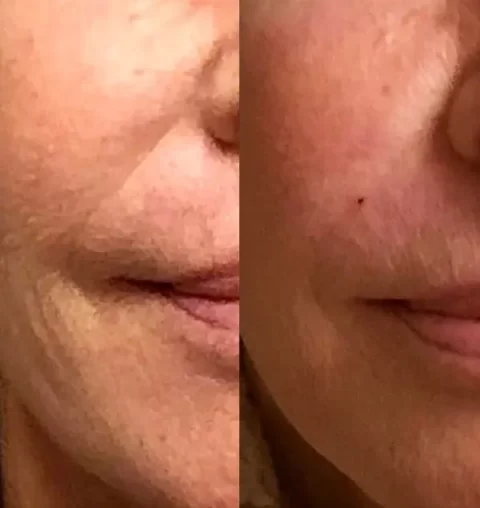 Injectables before and after photos showcasing a woman's transformed face.