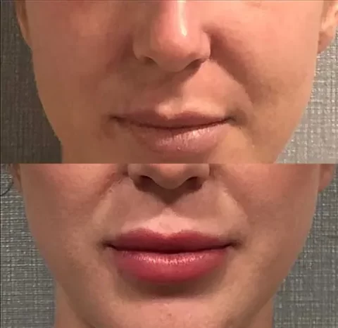 A woman's lips showcasing the transformative effects of lip injections through before and after photos.