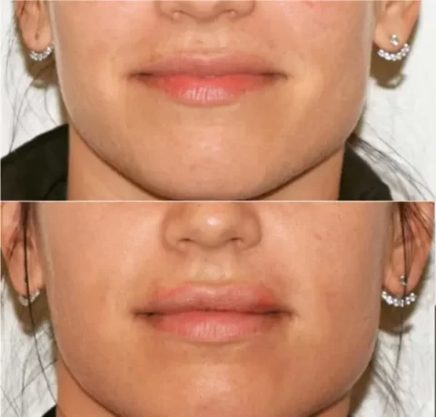 A woman's lips undergo a visible transformation after receiving lip injections, as shown in these injectables before and after photos.