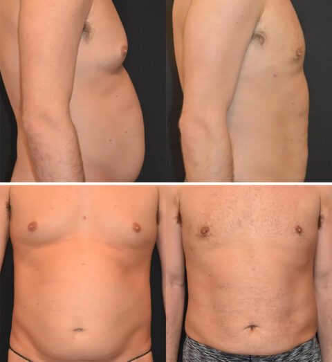 Liposuction before and after with tummy tuck results.