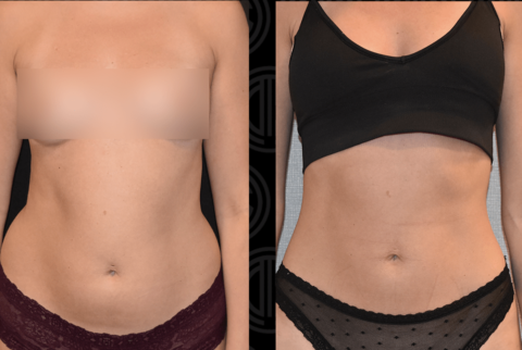 Liposuction before and after results, including tummy tuck transformation.