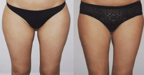 Liposuction Before and After pictures of a woman in a black panty.