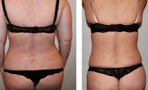 Liposuction before and after pictures of a woman's tummy tuck.