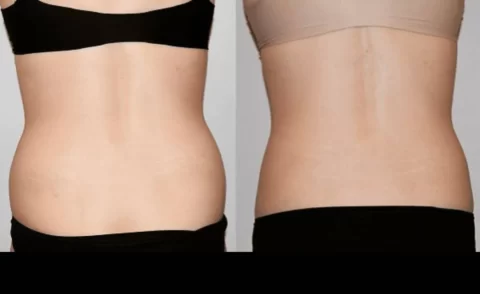 Tummy tuck and liposuction before and after transformations.