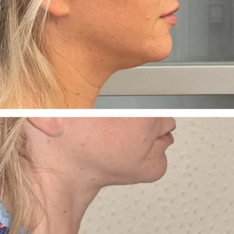 A woman's neck transformed with liposuction, showcasing the impressive before and after results.