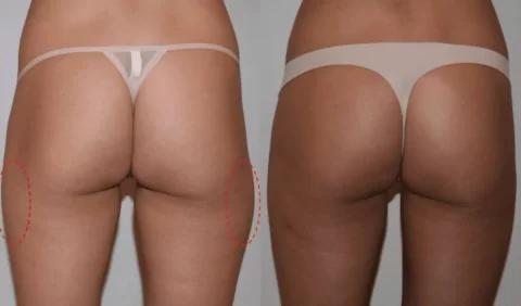 Two photos showcasing the noticeable transformation of a woman's buttocks after undergoing liposuction.