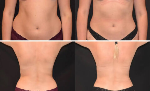 Tummy tuck and liposuction before and after.