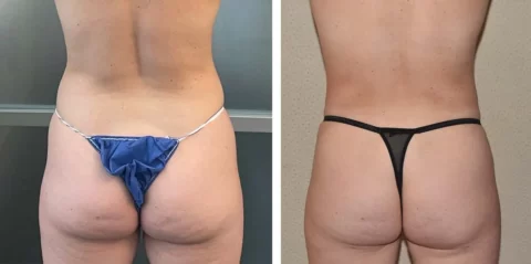 Tummy tuck and Liposuction before and after photos.