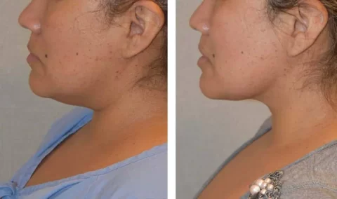 A woman's neck before and after undergoing liposuction.