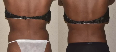 A woman's back before and after liposuction and tummy tuck surgery.