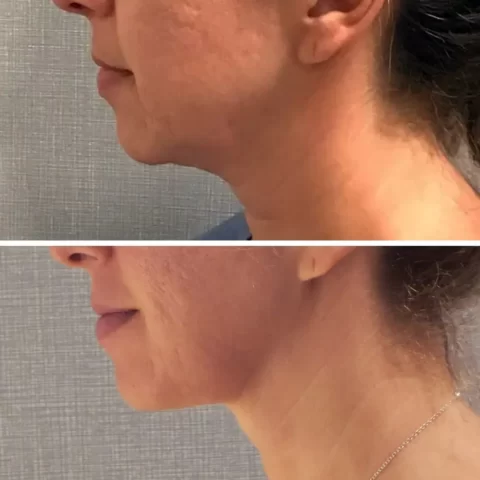 Liposuction Before and After photos of a woman's neck.