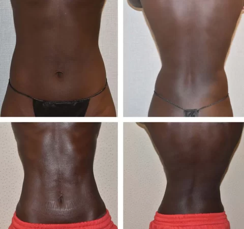 Liposuction before and after results for tummy tuck.