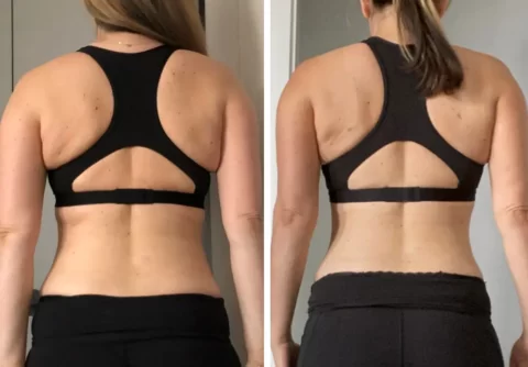 A woman's back before and after a workout with possible liposuction transformation.