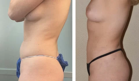 Liposuction before and after showcasing the transformative results.