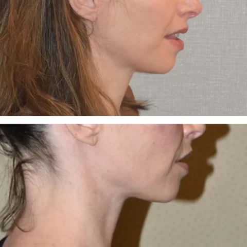 A woman's neck transformation before and after liposuction.