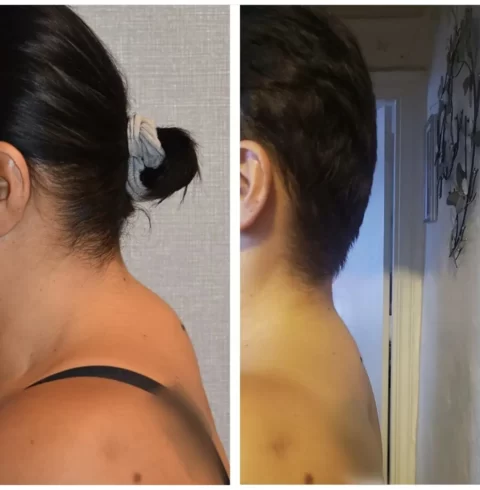 A woman's neck before and after a neck lift and liposuction.